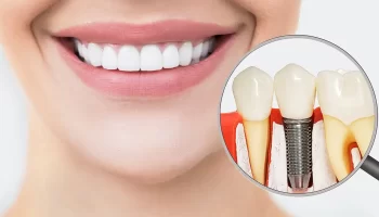 The Complete Guide to Dental Implants: Everything You Need to Know